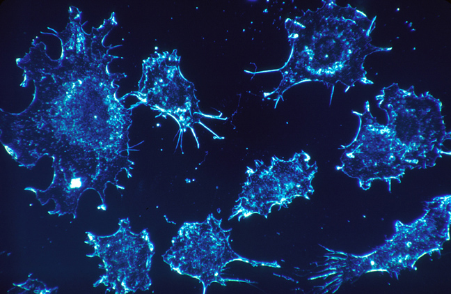 cancer cells. Histology: Cancer Cells