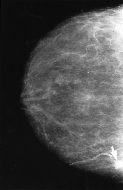 Diagnosis: Mammogram: Cancer (obvious). preview