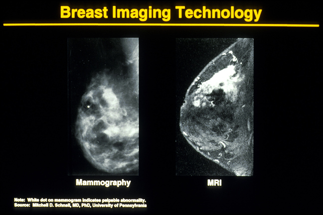 Diagnosis: Mammogram vs.
