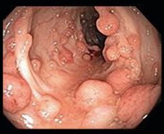 Familial Adenomatous Polyposis