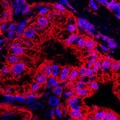 Mitochondrial Shape in Pancreatic Cancer