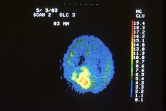 PET Scan of Brain Tumor: Image Details - NCI Visuals Online