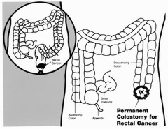 Permanent Colostomy Illustration: Image Details - NCI Visuals Online