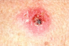 Crusty Skin Lump: Image Details - NCI Visuals Online