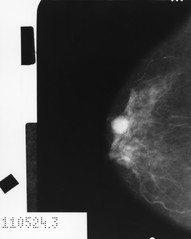 Mammogram Showing Cancer: Image Details - NCI Visuals Online