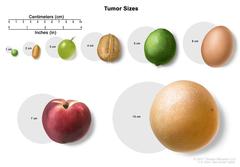 Kidney Tumor Size Chart