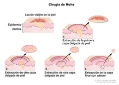 Cirugía de Mohs (Surgery, Mohs): Image Details - NCI Visuals Online