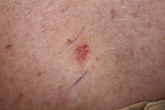 Skin Cancer Basal Cell Carcinoma Superficial Image Details Nci Visuals Online