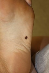 melanoma on big toe