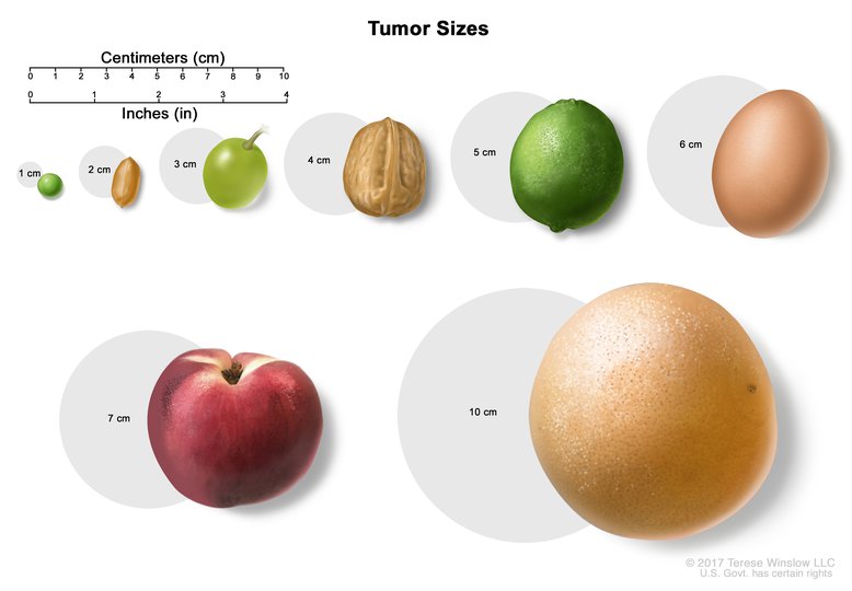 Bewust worden kan zijn schokkend Tumor Size - Centimeters: Image Details - NCI Visuals Online