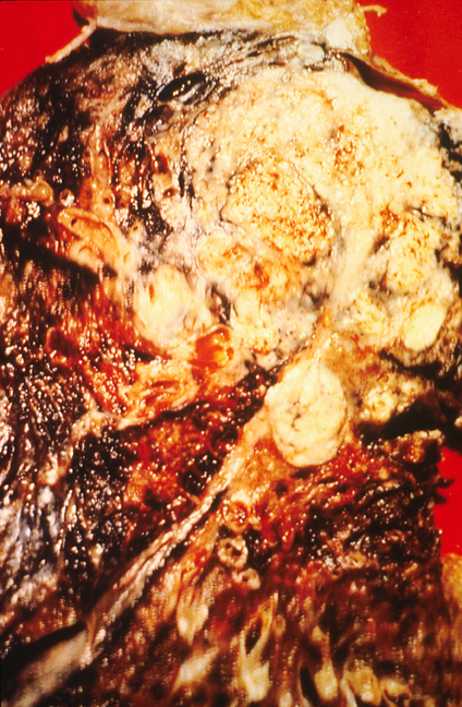 Cross section of a human lung. The white area in the upper lobe is cancer, the black areas indicate the patient was a smoker.<br />—<br />Harmful effects of cigarette smoke by National Cancer Institute [Public Domain]