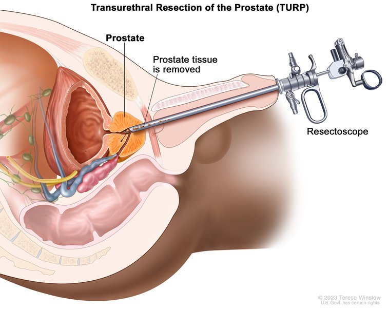 prostate operation types