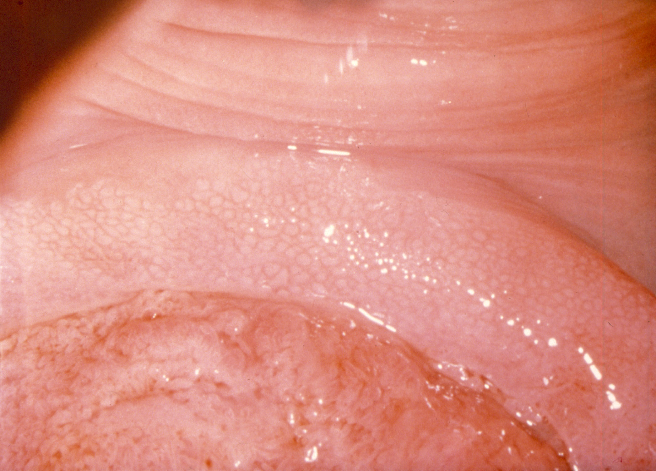 Vaginal jästinfektion huskurer