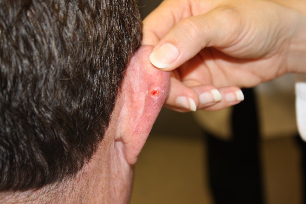 Related image of Skin Cancer On Ear 